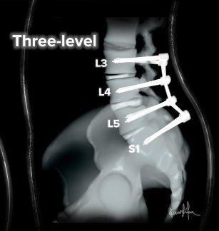 two-three-level-spinal-fusion.jpg